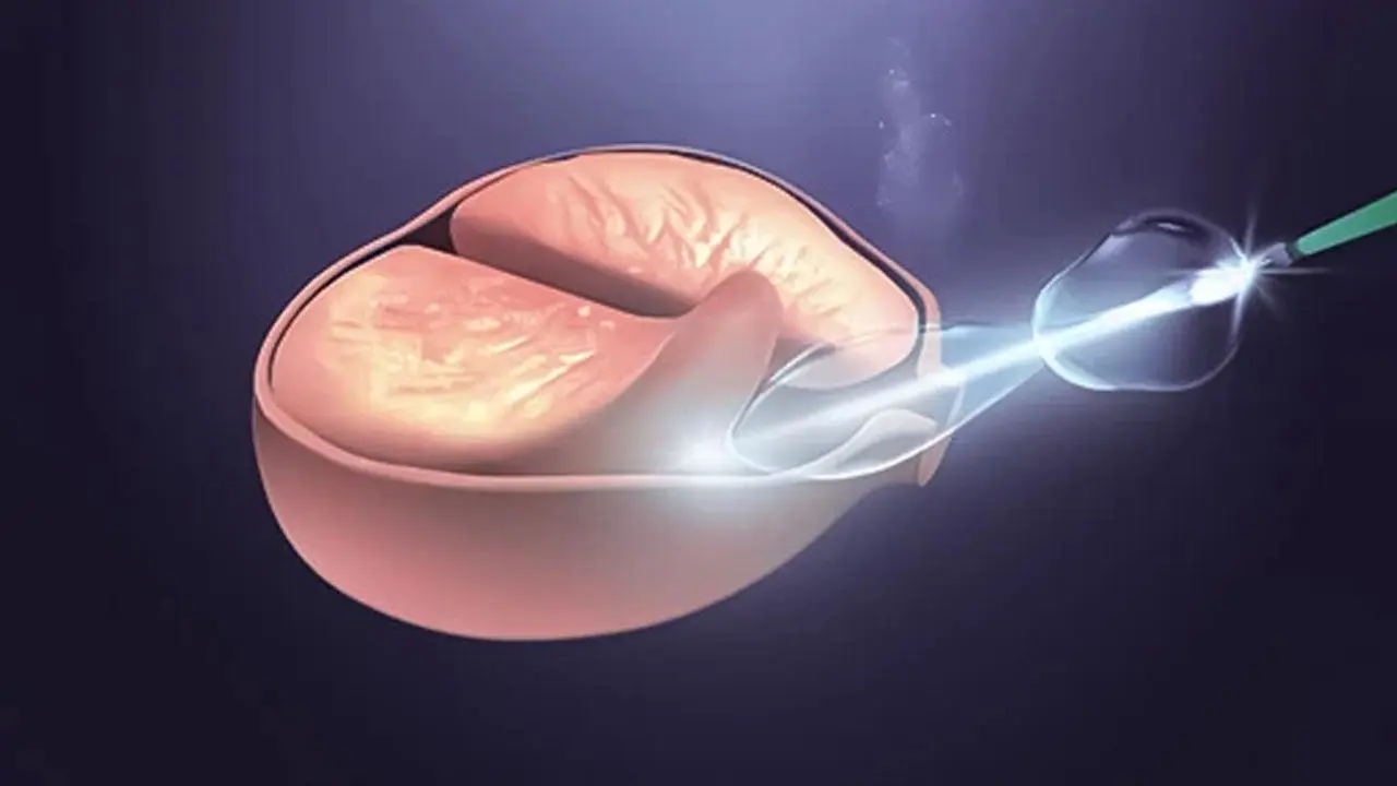 HOLEP (Holmium Lazer Prostat Ameliyatı) ile Prostat Büyümesi