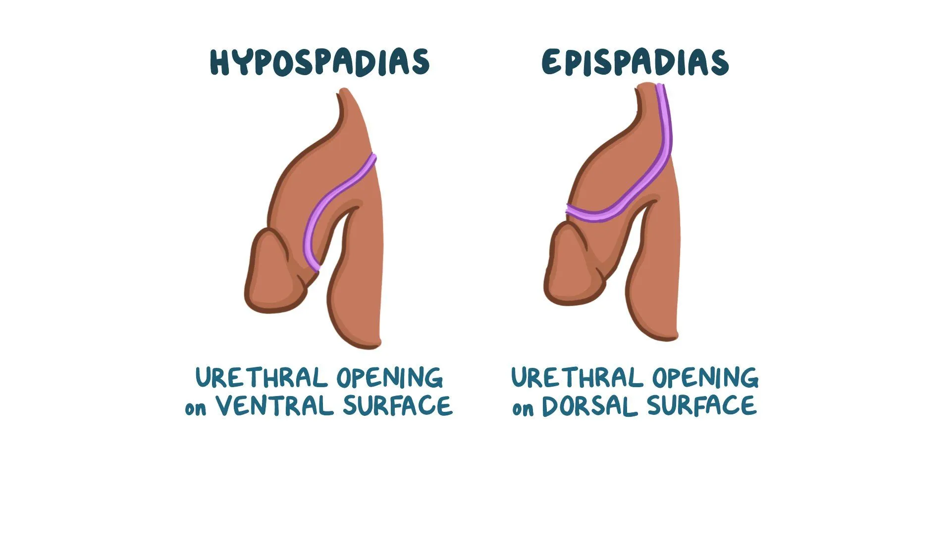 Hipospadias