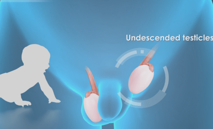 İnmemiş Testis