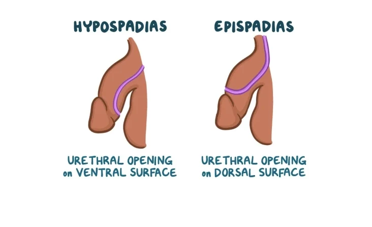 Hipospadias
