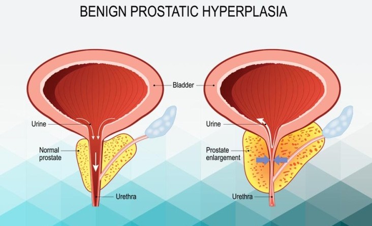 İyi Huylu Prostat Büyümesi (BPH)