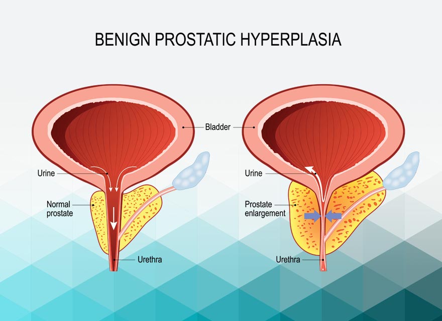 İyi Huylu Prostat Büyümesi (BPH)